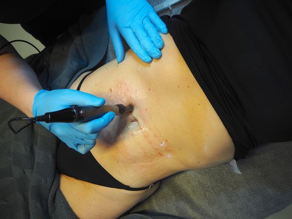 Jeg tester Dermapen og Mesoterapi mot slapp magehud, i døll truse.